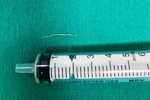 Sợi kim loại nằm trong cổ bé gái 8 tháng tuổi suốt thời gian dài