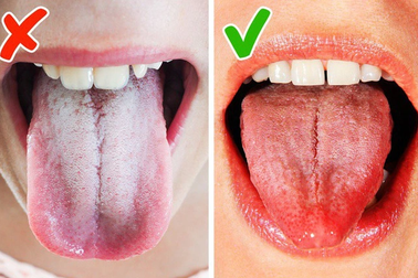 Lưỡi có dấu hiệu này, không đau ốm gì cũng cần đi khám ngay
