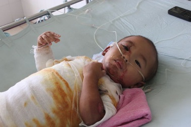 Bé 2 tuổi nguy kịch vì bỏng nước sôi toàn thân