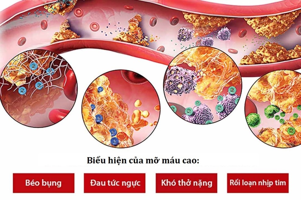Mỡ máu: Sát thủ thầm lặng ngày càng trẻ hóa - 1 Mỡ máu: Sát thủ thầm lặng ngày càng trẻ hóa - 1