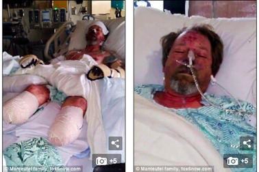 Người đàn ông phải cắt bỏ tất cả chân tay vì bị chó liếm