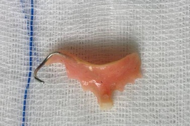 Cụ bà nuốt chửng răng giả trong khi uống thuốc