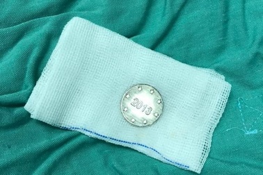 Quảng Bình: Chơi đồng xu, bé trai 5 tuổi nuốt luôn vào thực quản