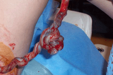 Miền Bắc đã có ngân hàng máu cuống rốn