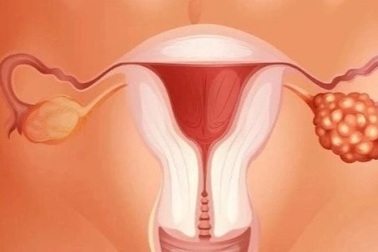 Phương pháp điều trị nào tối ưu với ung thư buồng trứng?