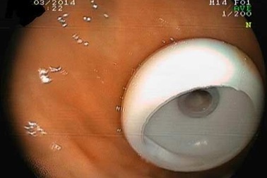 Lần đầu nội soi tạo miệng ăn trên bụng cụ già 95 tuổi 