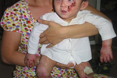 Thương vô cùng bé 13 tháng tuổi bị bệnh “lột da ếch”