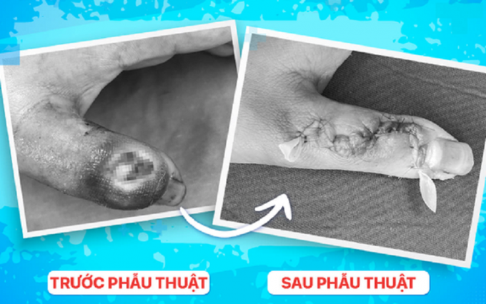 Ngón tay của bệnh nhi trước và sau phẫu thuật (ảnh NM).