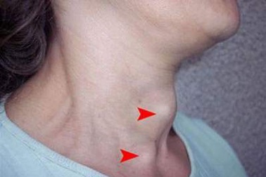 Lượng tiêu thụ muối i-ốt giảm nửa, cảnh báo nguy cơ IQ thấp ở trẻ