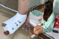 Cô gái ở TPHCM hoại tử khi ngâm nước nóng, đi 4 bệnh viện vẫn mất ngón chân
