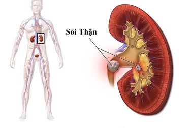 Tác động nghiêm trọng của sỏi thận đến cơ thể