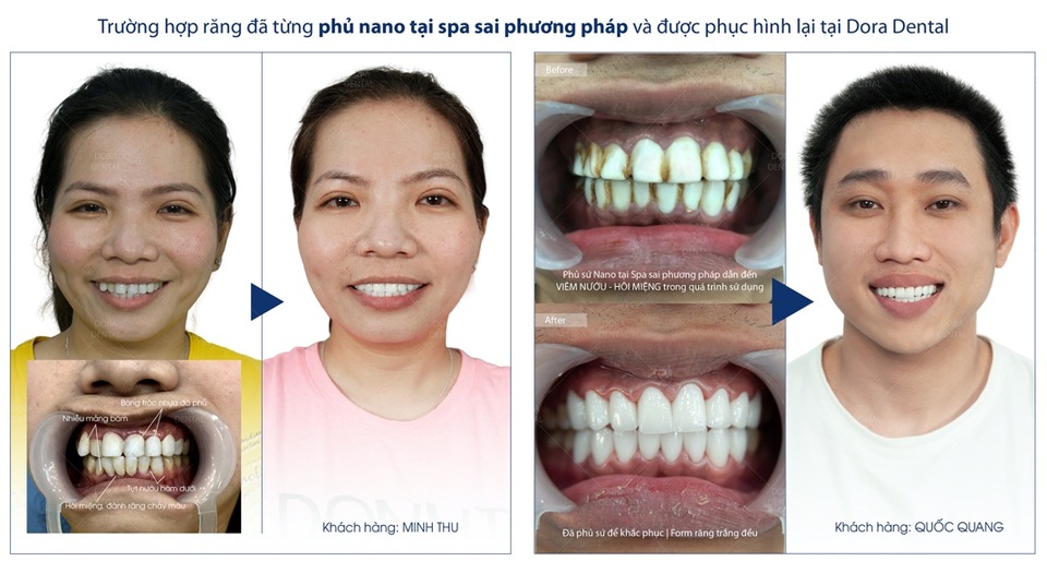 Phục hình răng sứ thẩm mỹ tại Dora có đáng lo ngại? - 5 Phục hình răng sứ thẩm mỹ tại Dora có đáng lo ngại? - 5