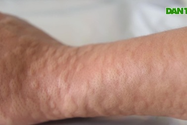 Lạ lùng nghề ngồi im cho muỗi đốt, hàng trăm con bâu đen kịt tay ở Hà Nội