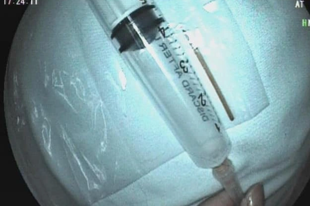 Gắp cây tăm xuyên qua thực quản cụ ông 84 tuổi - 1 Gắp cây tăm xuyên qua thực quản cụ ông 84 tuổi - 1