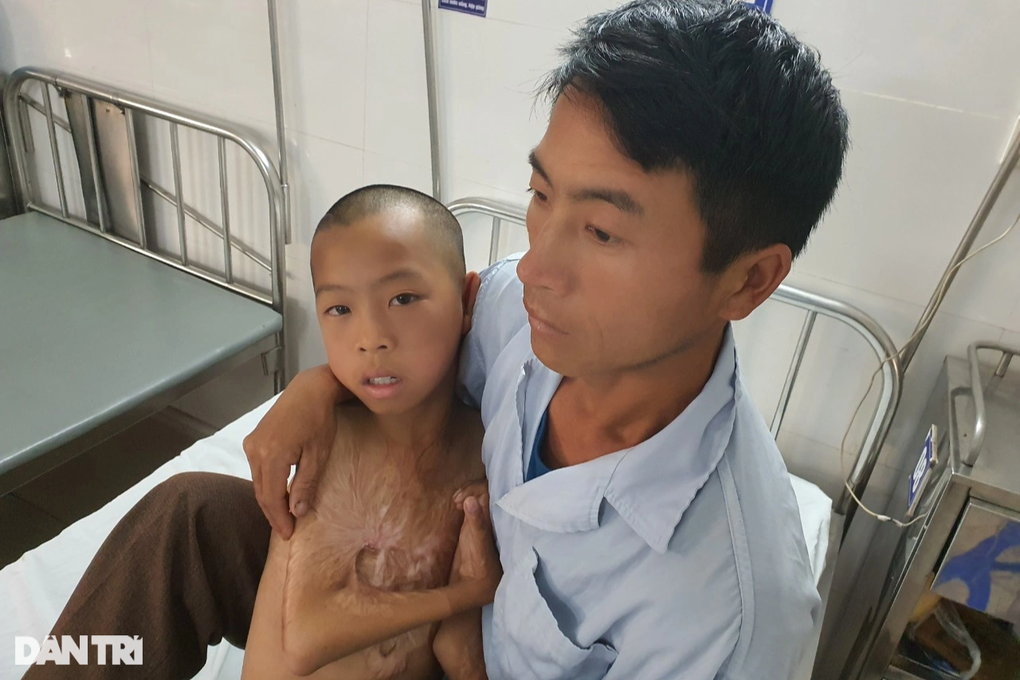 Nghẹn đắng trước cơ thể biến dạng khủng khiếp do bỏng của bé trai 14 tuổi - 5 Nghẹn đắng trước cơ thể biến dạng khủng khiếp do bỏng của bé trai 14 tuổi - 5