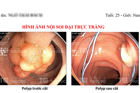 Chàng trai 25 tuổi ôm "quả bom nổ chậm" 4cm trong lòng đại tràng