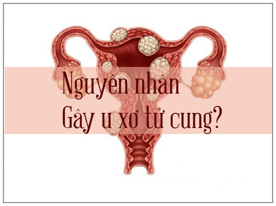 Nguyên nhân gây u xơ tử cung và cách phòng ngừa, cải thiện hiệu quả nhờ Nga Phụ Khang - 1 Nguyên nhân gây u xơ tử cung và cách phòng ngừa, cải thiện hiệu quả nhờ Nga Phụ Khang - 1