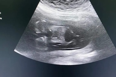 Thai phụ trẻ được phát hiện cặp song thai dính nhau, chung một quả tim