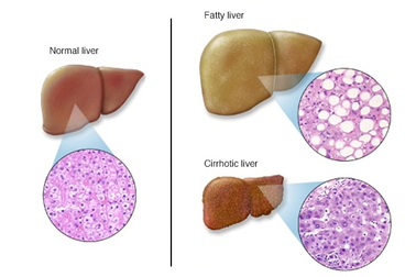 Có dấu hiệu này chứng tỏ gan của bạn đang "kêu cứu"