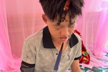 Nam sinh lớp 10 nghi bị học sinh lớp 8 đánh gãy xương tay, chấn thương đầu