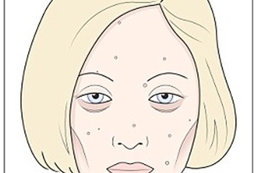 Biểu hiện của bị dị ứng thực phẩm bơ sữa và lúa mì trên gương mặt