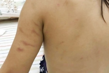 Bé gái 2 tuổi xuất hiện những vết bầm tím trên người lúc ở trường mầm non
