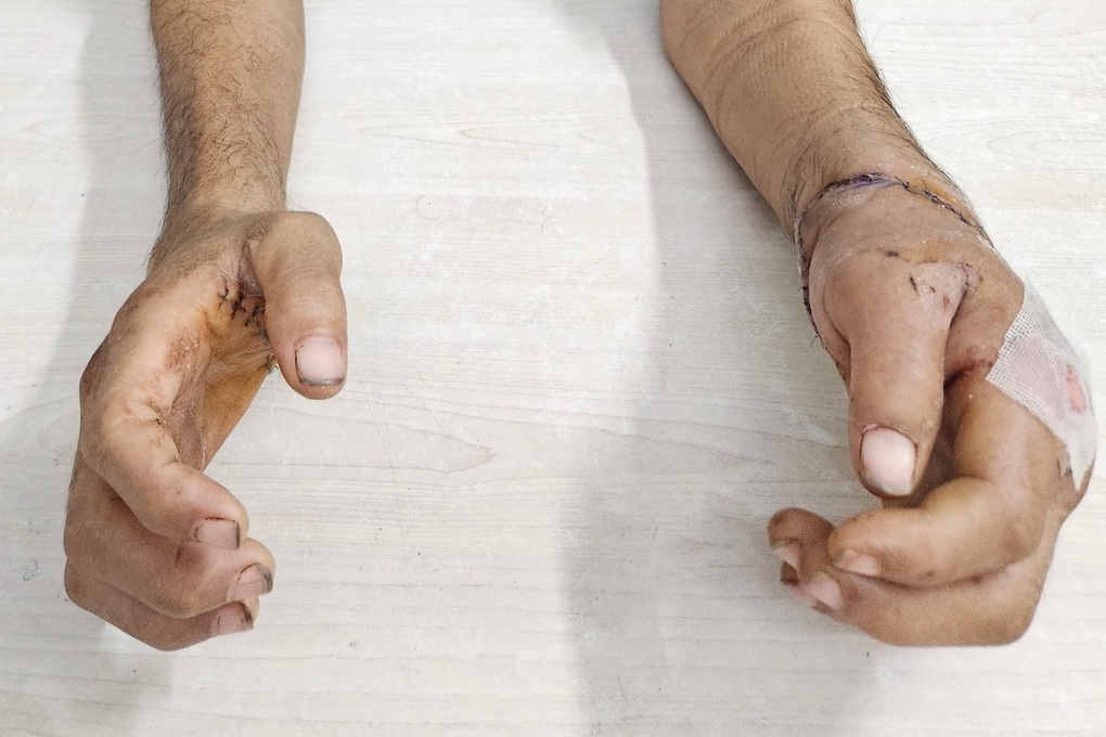 Egy 40 éves férfinak mindkét keze leszakadt, miután összeveszett a szomszédaival - 2 Ẩu đả với hàng xóm, người đàn ông 40 tuổi bị chém đứt cả 2 bàn tay - 2