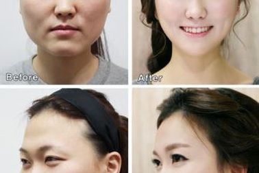 Chuyện bi hài sau những ca phẫu thuật thẩm mỹ “quá đà”