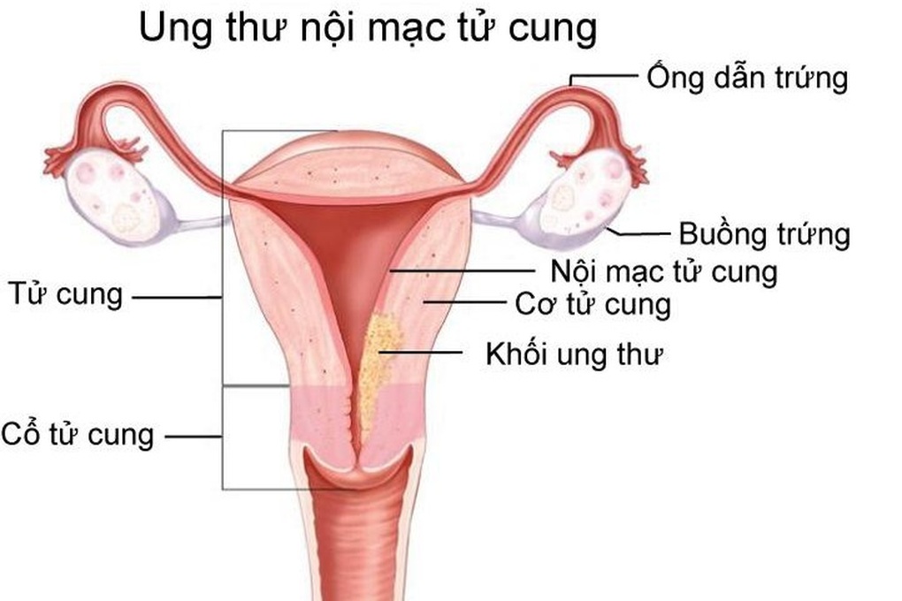 Dấu hiệu chỉ điểm ung thư nội mạc tử cung - 1 Dấu hiệu chỉ điểm ung thư nội mạc tử cung - 1