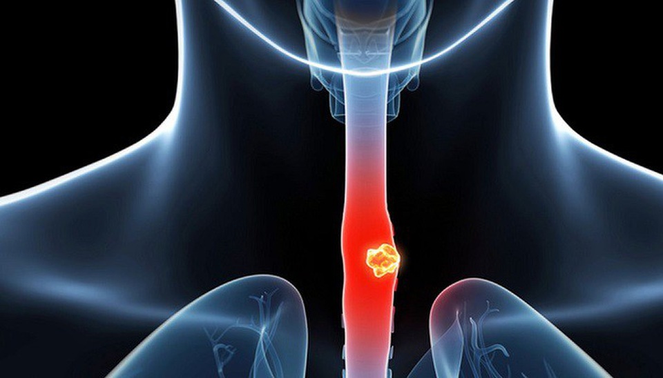 Chăm sóc bệnh nhân sau xạ trị ung thư thực quản - 1 Chăm sóc bệnh nhân sau xạ trị ung thư thực quản - 1