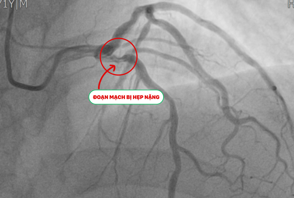 Phát hiện tổn thương tim trước ca mổ cột sống, cụ ông được xử trí kịp thời - 1 Phát hiện tổn thương tim trước ca mổ cột sống, cụ ông được xử trí kịp thời - 1