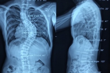 Nam thanh niên có cột sống uốn lượn như… xương rắn