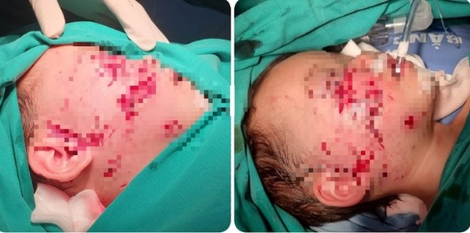 Bệnh nhi N.Đ.N. 28 tháng tuổi khi được đưa đến cấp cứu tại Bệnh viện.