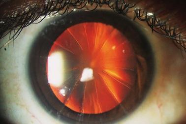 Phát hiện nhãn cầu của một người phụ nữ giống… bánh pizza