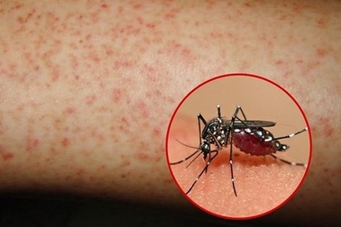 Khánh Hòa: Sốt xuất huyết tăng cao, hơn 6.000 ca mắc trong năm 2018