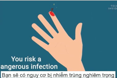 Điều gì sẽ xảy ra nếu bạn để một mảnh dằm trong da quá lâu?