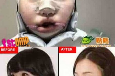 Những hậu quả khủng khiếp khi phẫu thuật thẩm mỹ