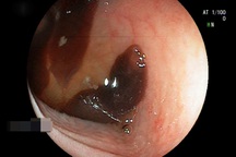 Phát hiện ổ sán bám chặt vào thành ruột người bệnh