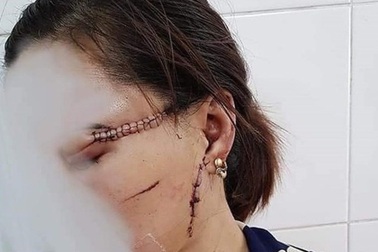 Chồng hờ dùng dao rạch mặt, cắt gân chân vợ vì ghen