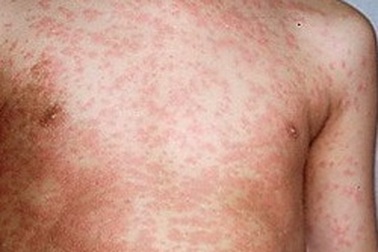 Hà Nội: Bùng phát dịch sởi ở người lớn