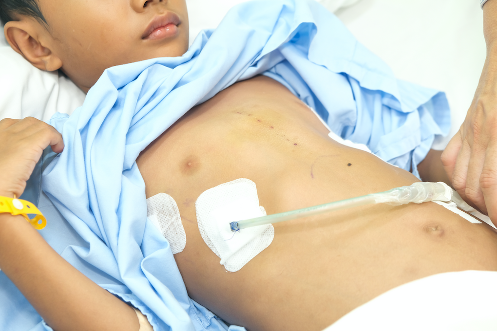 Phẫu thuật tái tạo lồng ngực cho bé trai 9 tuổi bị lõm ngực bẩm sinh nặng - 4 Phẫu thuật tái tạo lồng ngực cho bé trai 9 tuổi bị lõm ngực bẩm sinh nặng - 4