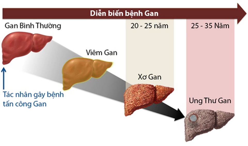 Chìa khóa vàng bảo vệ lá gan của bạn - 1 Chìa khóa vàng bảo vệ lá gan của bạn - 1