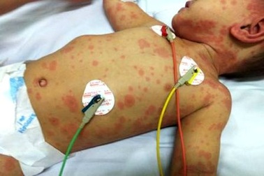 TPHCM: Bé 5 tháng tuổi tử vong do viêm não mô cầu