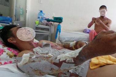 Bỏng nặng vì “tắm” bằng hóa chất thông cống