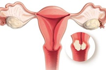Các giai đoạn của ung thư nội mạc tử cung