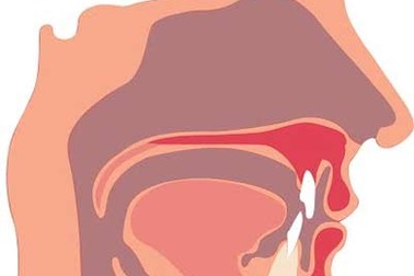 Chữa viêm xoang đơn giản, hiệu quả