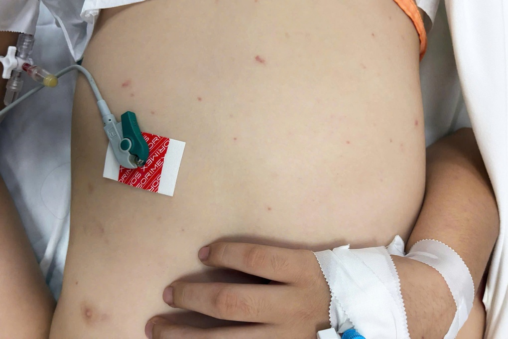 Bé trai 13 tuổi bỗng đau đầu dữ dội vì bệnh hiểm ở não dễ lây qua giọt bắn - 2 Bé trai 13 tuổi bỗng đau đầu dữ dội vì bệnh hiểm ở não dễ lây qua giọt bắn - 2