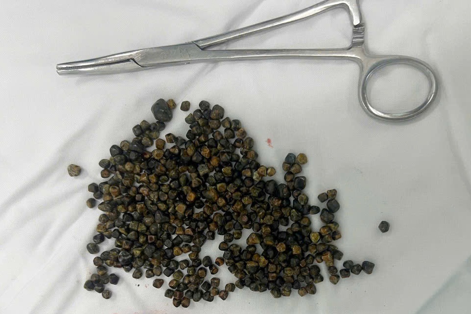Mổ ở Mỹ thất bại, nữ Việt kiều được bác sĩ tại TPHCM lấy 481 viên sỏi mật - 1