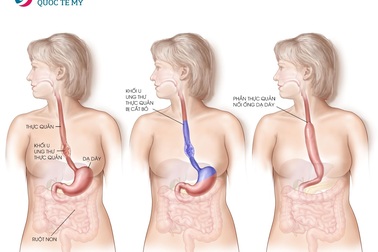 Điều trị ung thư thực quản tiêu chuẩn Mỹ ngay tại Việt Nam
