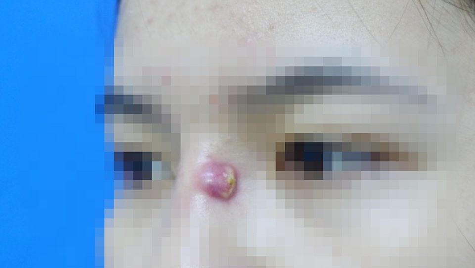 Cô gái trẻ bị mụn trứng cá mủ dai dẳng vì nguyên nhân không ngờ - 1 Cô gái trẻ bị mụn trứng cá mủ dai dẳng vì nguyên nhân không ngờ - 1